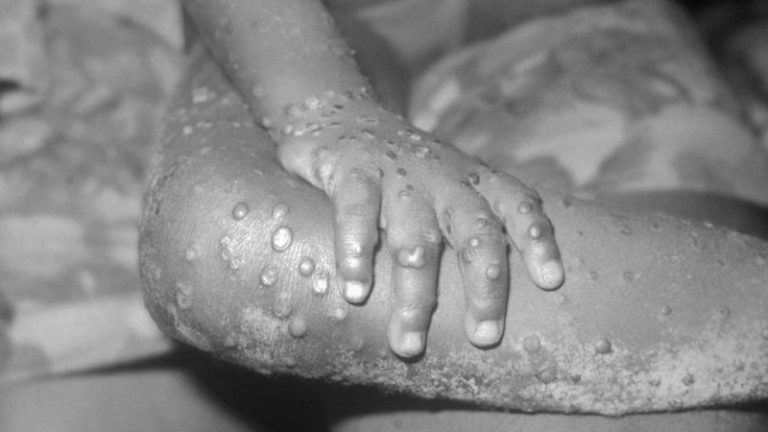 Monkeypox: How more than 200 contacts were tracked in US